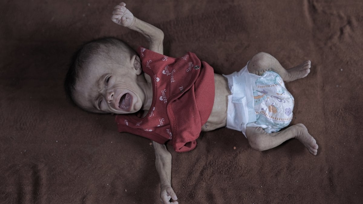 Gazze’de açlık: Filistinli bebeğin yaşam mücadelesi