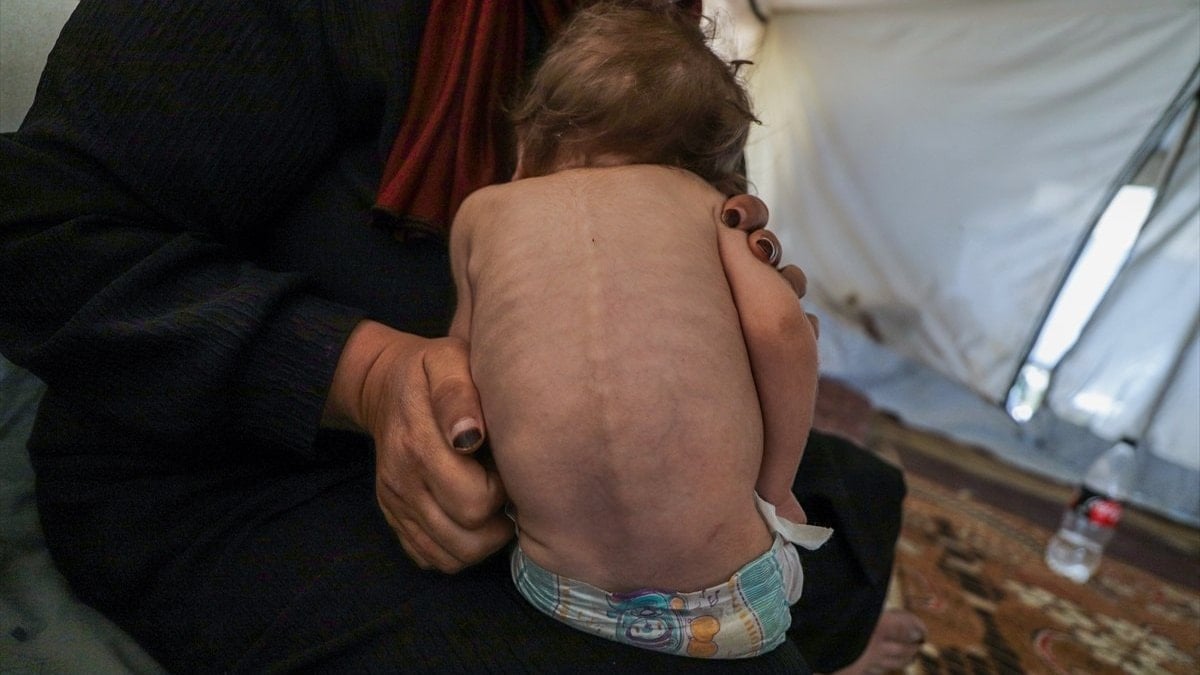 Gazze’de çocuklar hem açlık hem de hastalıkla mücadele ediyor