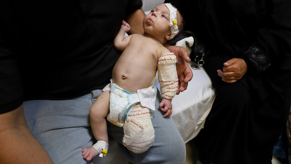Gazze’de bacağı ampute edilen Muhammed bebek, şimdi de elini kaybedebilir